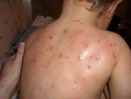 Bệnh tay chân miệng đã xuất hiện tại 62 tỉnh, thành Bệnh tay chân miệng đã xuất hiện tại 62 tỉnh, thành