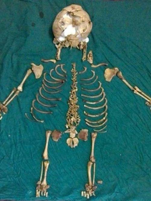 Bào thai nằm suốt 36 năm trong bụng mẹ