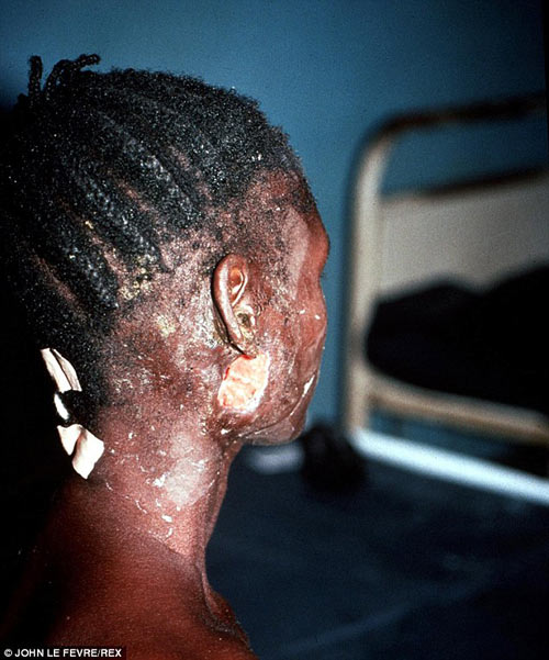 Nỗi ám ảnh khủng khiếp của bác sỹ ở tâm dịch Ebola