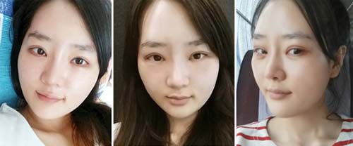 Sau 60 ngày, cô gái hàm bồ nông bỗng xinh như tiên nữ - Ảnh 7. Sau 60 ngày, cô gái hàm bồ nông bỗng xinh như tiên nữ - Ảnh 7.