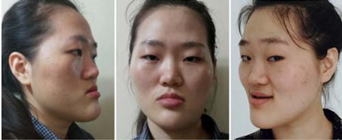 Sau 60 ngày, cô gái hàm bồ nông bỗng xinh như tiên nữ - Ảnh 3. Sau 60 ngày, cô gái hàm bồ nông bỗng xinh như tiên nữ - Ảnh 3.