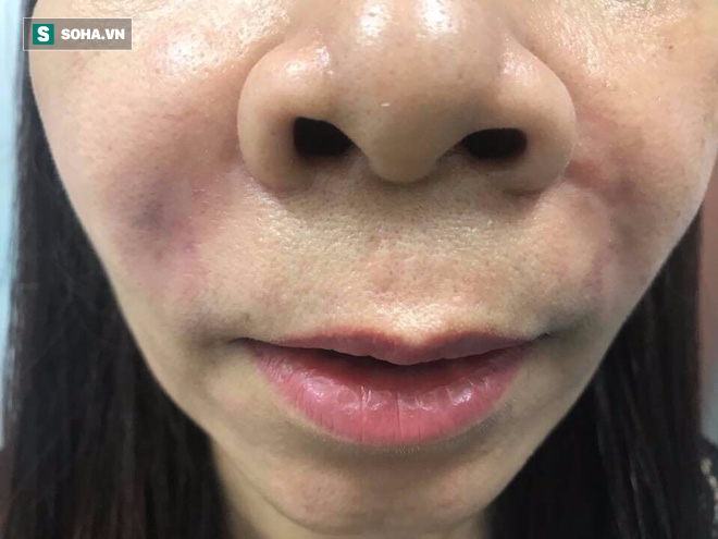 Cô suýt hoại tử mặt vì “ủng hộ spa” của cháu gái: Lời cảnh tỉnh về chất làm đầy filler - Ảnh 1. Cô suýt hoại tử mặt vì “ủng hộ spa” của cháu gái: Lời cảnh tỉnh về chất làm đầy filler - Ảnh 1.