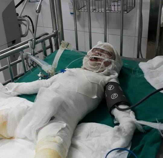 Sức khỏe - Xót thương cháu bé 2 tuổi ngã vào hố vôi đang sôi, bỏng trên 80% cơ thể