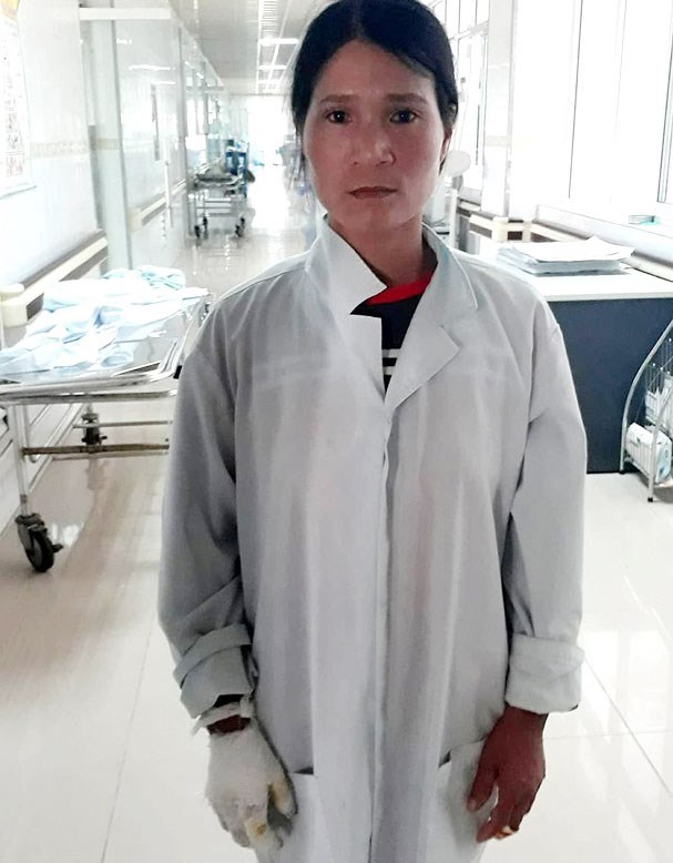 Sức khỏe - Xót thương cháu bé 2 tuổi ngã vào hố vôi đang sôi, bỏng trên 80% cơ thể (Hình 2).