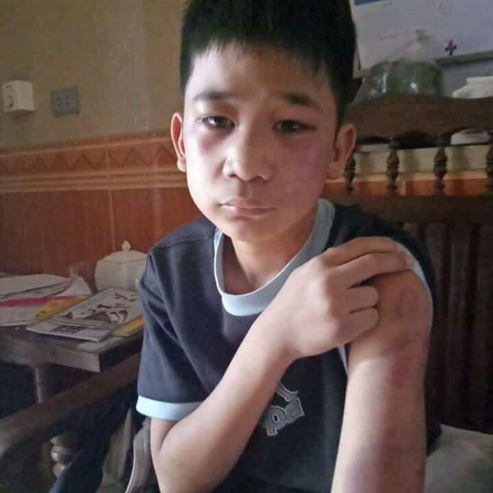 Tin nhanh - Hà Nội: Cậu bé bị bố và mẹ kế  đánh bầm tím