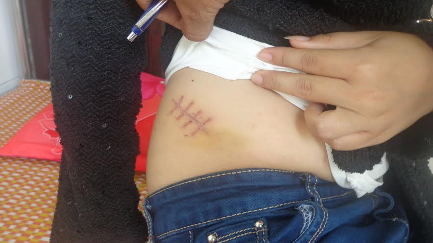 Sếp nữ dùng kéo đâm công nhân nhập viện