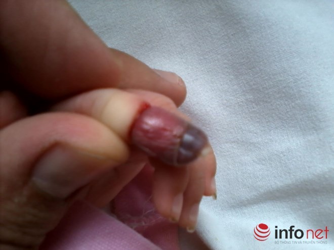 Hiểm họa từ bao tay, bao chân của trẻ sơ sinh