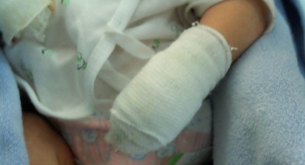 Rơi nước mắt bé trai sơ sinh lở loét khắp người bị bỏ rơi