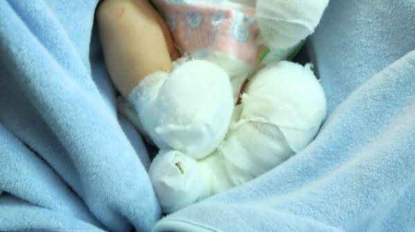 Rơi nước mắt bé trai sơ sinh lở loét khắp người bị bỏ rơi