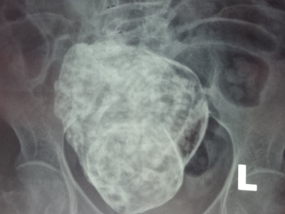 Hội chẩn liên viện trường hợp cụ bà 76 tuổi mang thai gần 30 năm