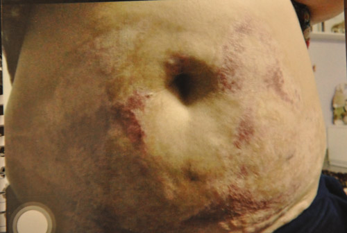 Phẫu thuật thẩm mỹ và những hình ảnh biến chứng kinh rợn