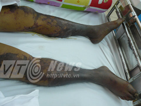 Ăn tiết canh dê, doanh nhân sắp mất mạng