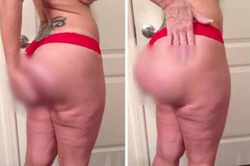 Video kinh hoàng về một trường hợp “độn” mông hỏng Video kinh hoàng về một trường hợp “độn” mông hỏng