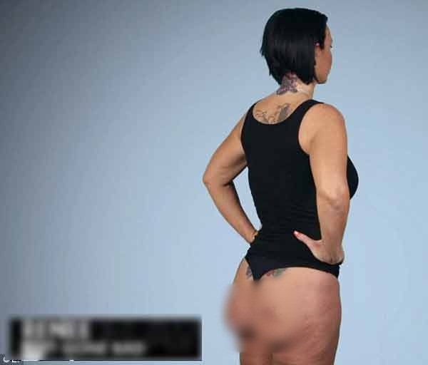 Video kinh hoàng về một trường hợp “độn” mông hỏng Video kinh hoàng về một trường hợp “độn” mông hỏng