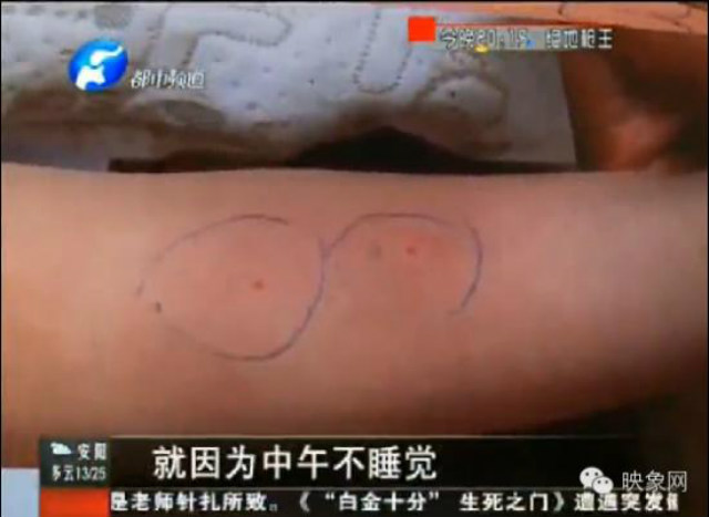 Bé 3 tuổi nhiễm trùng phổi nghi bị cô giáo châm kim khắp người