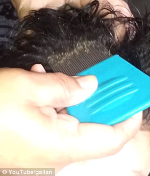 Kinh hãi hàng triệu con chấy “làm tổ” trên đầu bé gái Kinh hãi hàng triệu con chấy “làm tổ” trên đầu bé gái