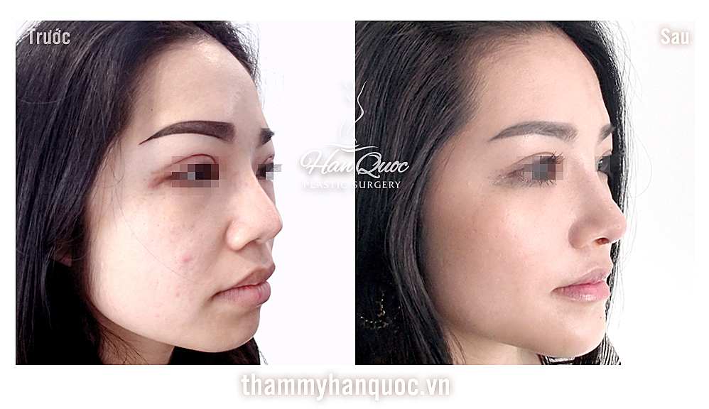 Bệnh viện thẩm mỹ Hàn Quốc Yeong Won - nơi giúp bạn thay đổi Bệnh viện thẩm mỹ Hàn Quốc Yeong Won - nơi giúp bạn thay đổi