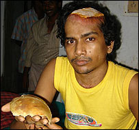 Người đàn ông bị xương sọ văng ra ngoài mà không chết Người đàn ông bị xương sọ văng ra ngoài mà không chết