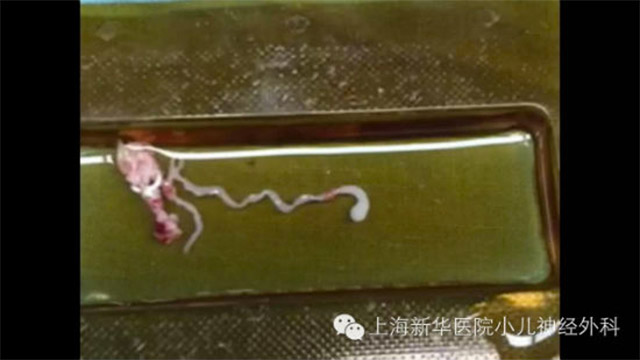 Kinh hãi giun dài 8 cm ký sinh trong não người