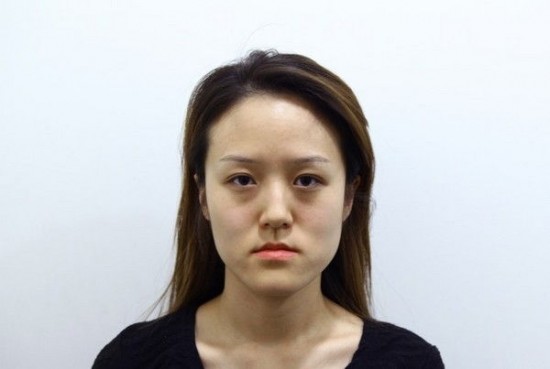 Kinh ngạc nhan sắc của chị em song sinh sau phẫu thuật thẩm mỹ