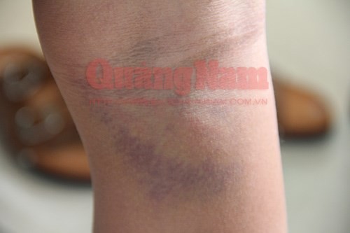 Quảng Nam: Hiệu phó đánh học sinh tới mức nhập viện Quảng Nam: Hiệu phó đánh học sinh tới mức nhập viện