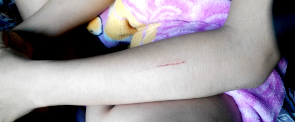 Nạn rạch mông - rạch đùi ở Ninh Hòa “lây lan” vào Nha Trang