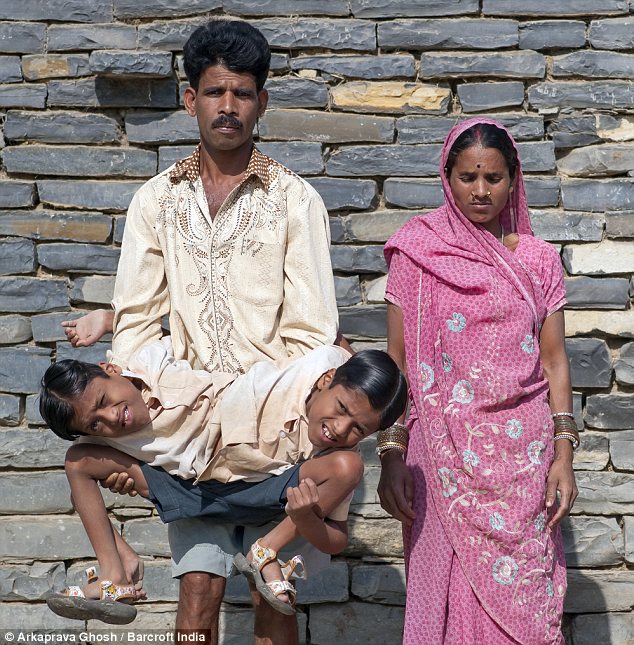 Cuộc sống thường nhật của hai bé trai song sinh dính liền Cuộc sống thường nhật của hai bé trai song sinh dính liền