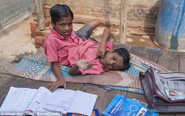 Cuộc sống thường nhật của hai bé trai song sinh dính liền Cuộc sống thường nhật của hai bé trai song sinh dính liền