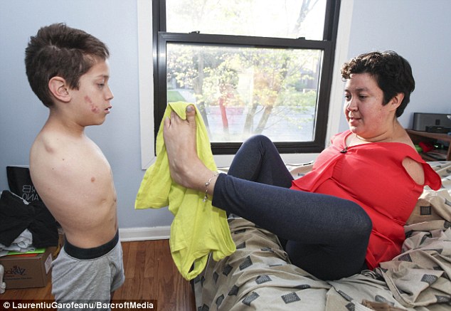 Mắc bệnh hiếm, hai mẹ con đều bị cụt hai tay