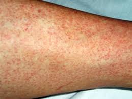 Dịch Ebola bùng phát: Triệu chứng ủ bệnh từ 2 – 21 ngày là gì? Dịch Ebola bùng phát: Triệu chứng ủ bệnh từ 2 – 21 ngày là gì?