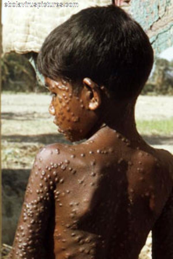 Bệnh Ebola: Bố mẹ qua đời, bé gái bị dân làng “ghẻ lạnh” tới chết