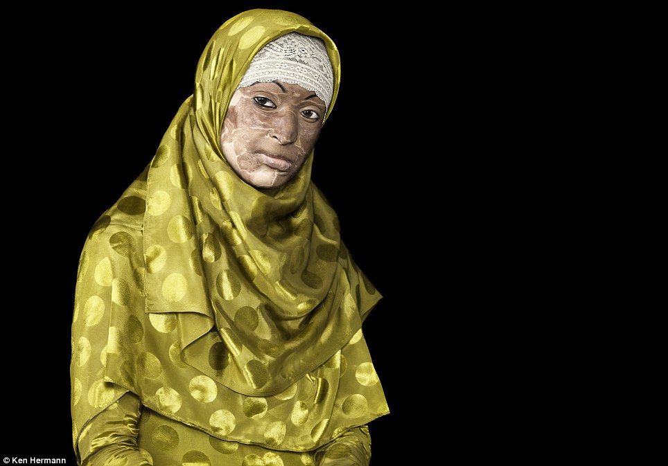 Những khuôn mặt biến dạng kinh hoàng vì axit