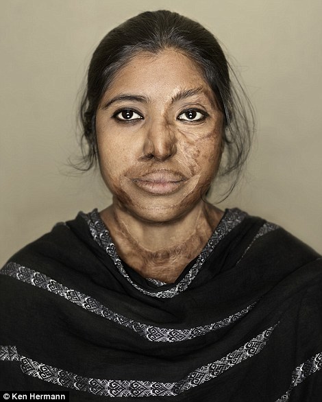 Những khuôn mặt biến dạng kinh hoàng vì axit