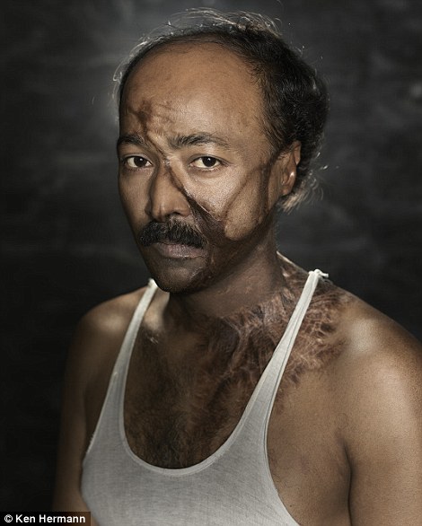 Những khuôn mặt biến dạng kinh hoàng vì axit