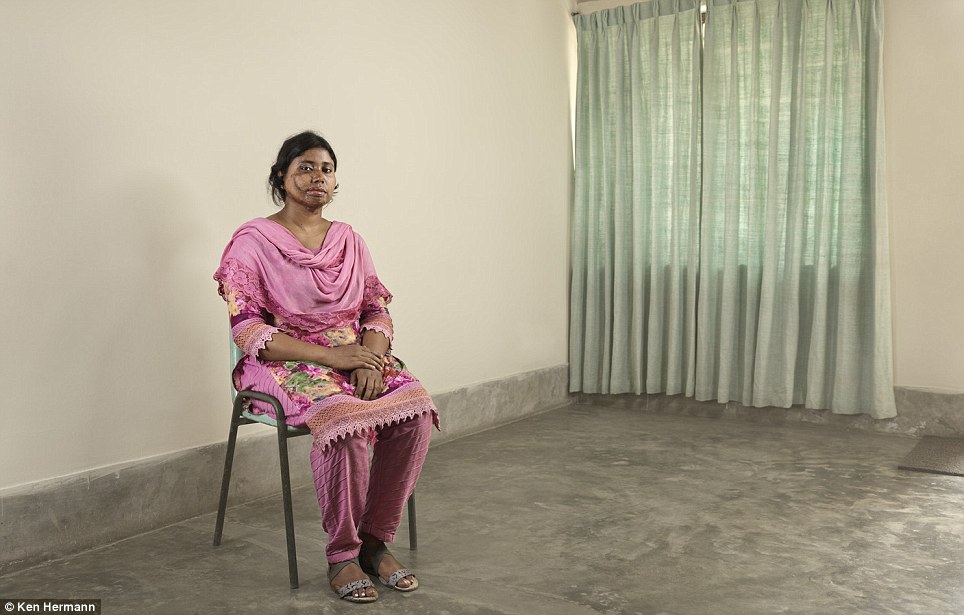 Những khuôn mặt biến dạng kinh hoàng vì axit