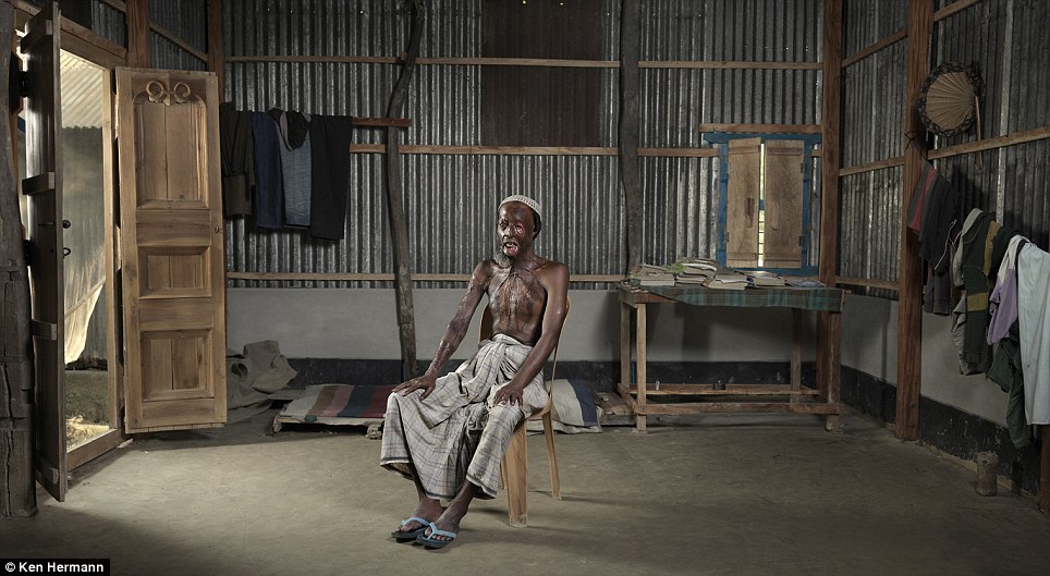 Những khuôn mặt biến dạng kinh hoàng vì axit