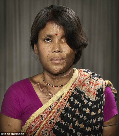 Những khuôn mặt biến dạng kinh hoàng vì axit