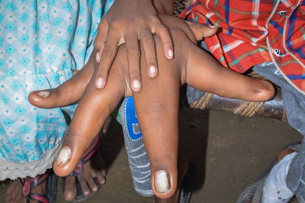 Mắc bệnh lạ, bé trai có bàn tay khổng lồ như…chân voi