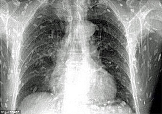 Kinh hãi sán làm “tổ” khắp người vì nghiện sushi