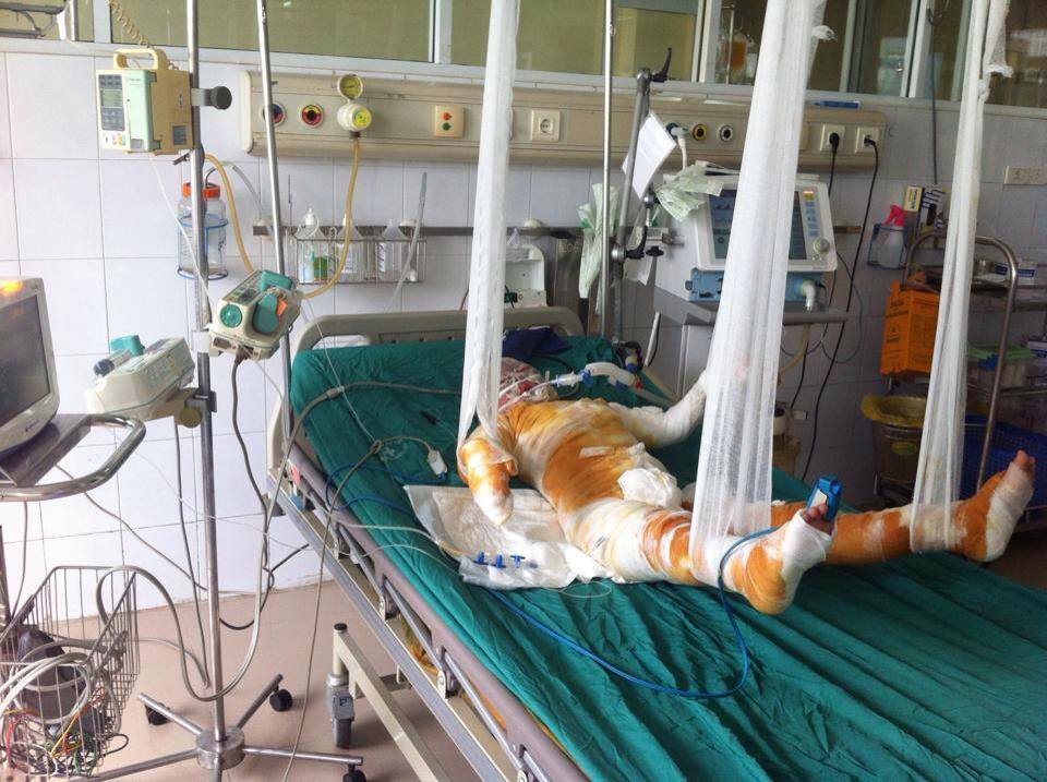 Ứa nước mắt cảnh cả nhà bỏng nặng do dùng xăng tẩy nhựa đường Ứa nước mắt cảnh cả nhà bỏng nặng do dùng xăng tẩy nhựa đường