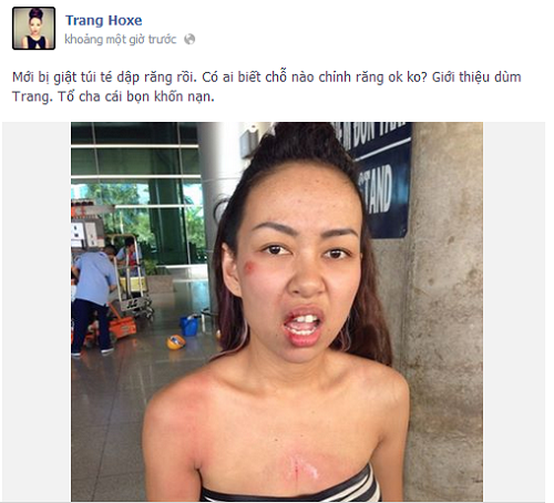 Thảo Trang bị gẫy răng vì gặp cướp 