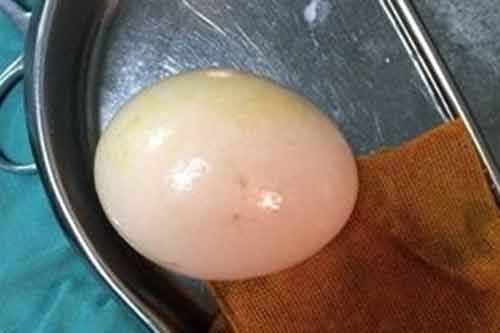 Nghịch dại, chồng nhét trứng vào “chỗ kín” của vợ