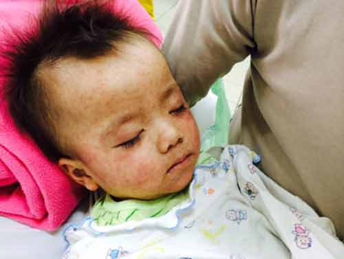 Dịch sởi hoành hành khiến các bà mẹ có con nhỏ hoang mang 