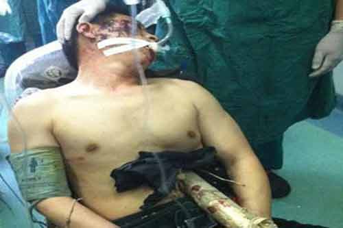 Thoát chết thần kỳ sau khi thanh gỗ dài 6m xuyên qua bụng Thoát chết thần kỳ sau khi thanh gỗ dài 6m xuyên qua bụng