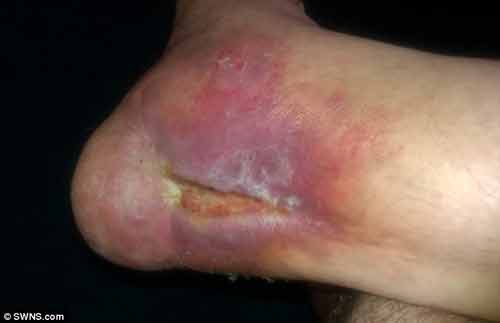 Người đàn ông có vết thương hở suốt 8 năm không lành hoàn toàn Người đàn ông có vết thương hở suốt 8 năm không lành hoàn toàn