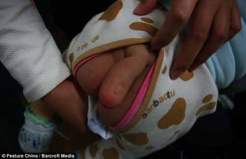 Bà mẹ cầu xin các bác sĩ phẫu thuật “cắt đuôi” cho con trai