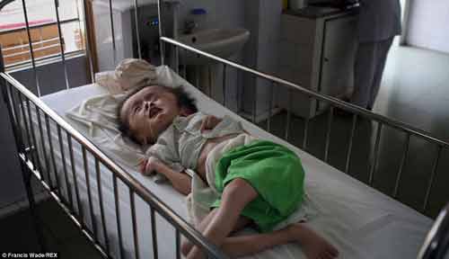 Xót xa hình ảnh trẻ em Việt nhiễm chất độc da cam trên báo Anh Xót xa hình ảnh trẻ em Việt nhiễm chất độc da cam trên báo Anh