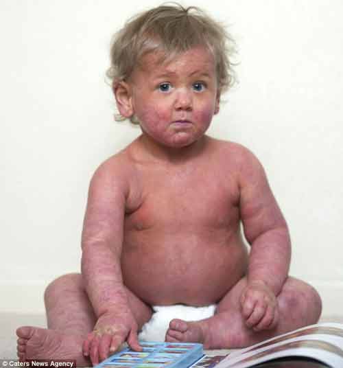 Cậu bé có làn da kỳ lạ như thể bị bỏng rộp