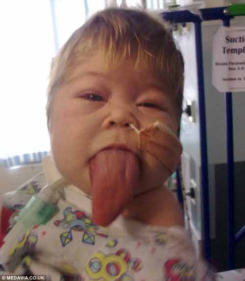 Em bé có cái lưỡi phát triển to đáng sợ sắp đi học Em bé có cái lưỡi phát triển to đáng sợ sắp đi học