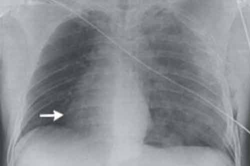 Sống sót thần kỳ dù tim bị xoay lệch 90 độ sau tai nạn mô tô Sống sót thần kỳ dù tim bị xoay lệch 90 độ sau tai nạn mô tô